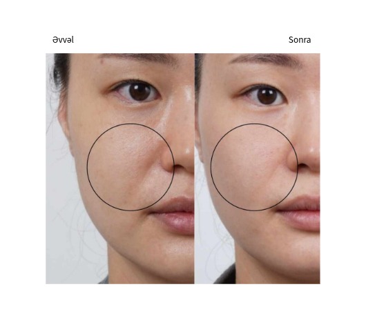 Classys Ultraformer MPT